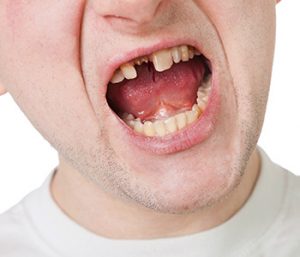 Dr. Daniel Cobb, Alex Bell Dental Image Of Broken Tooth