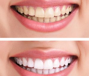 Dr. Daniel Cobb, Alex Bell Dental Image Of Before and After Teeth