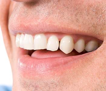 Dr. Daniel Cobb, Alex Bell Dental Kettering, OH area patients ask, "How do I care for my porcelain veneers?"