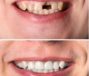 Dr. Daniel Cobb, Alex Bell Dental Image Of Before and After Broken teeth