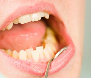 Wide range of Methods for treating Gum Disease from dentist in Centerville
