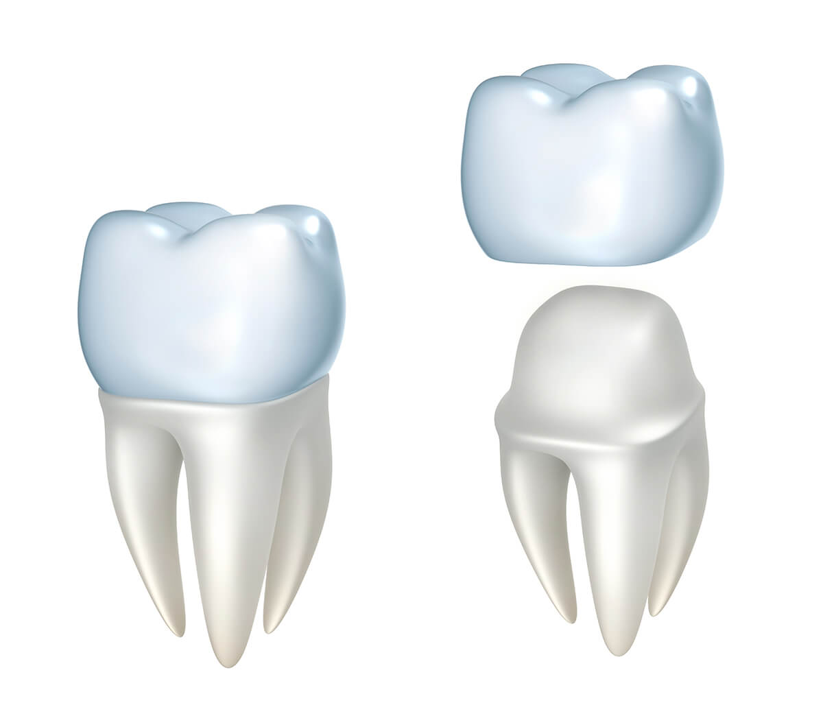 Dental Crown Procedure in Centerville OH Area